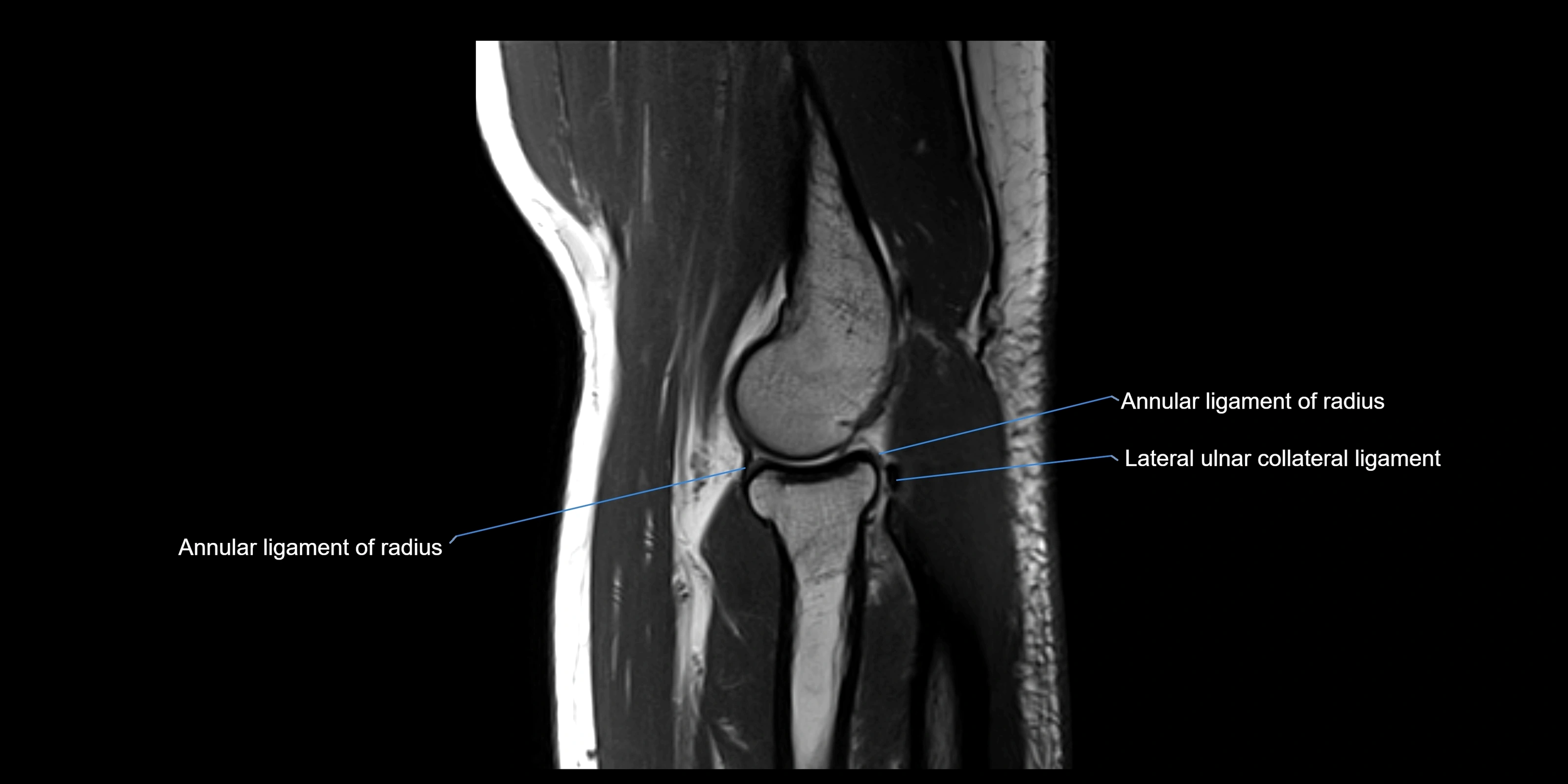 MRI elbow sagittal cross sectional anatomy 3T radiology  image-img-00001-00017.webp